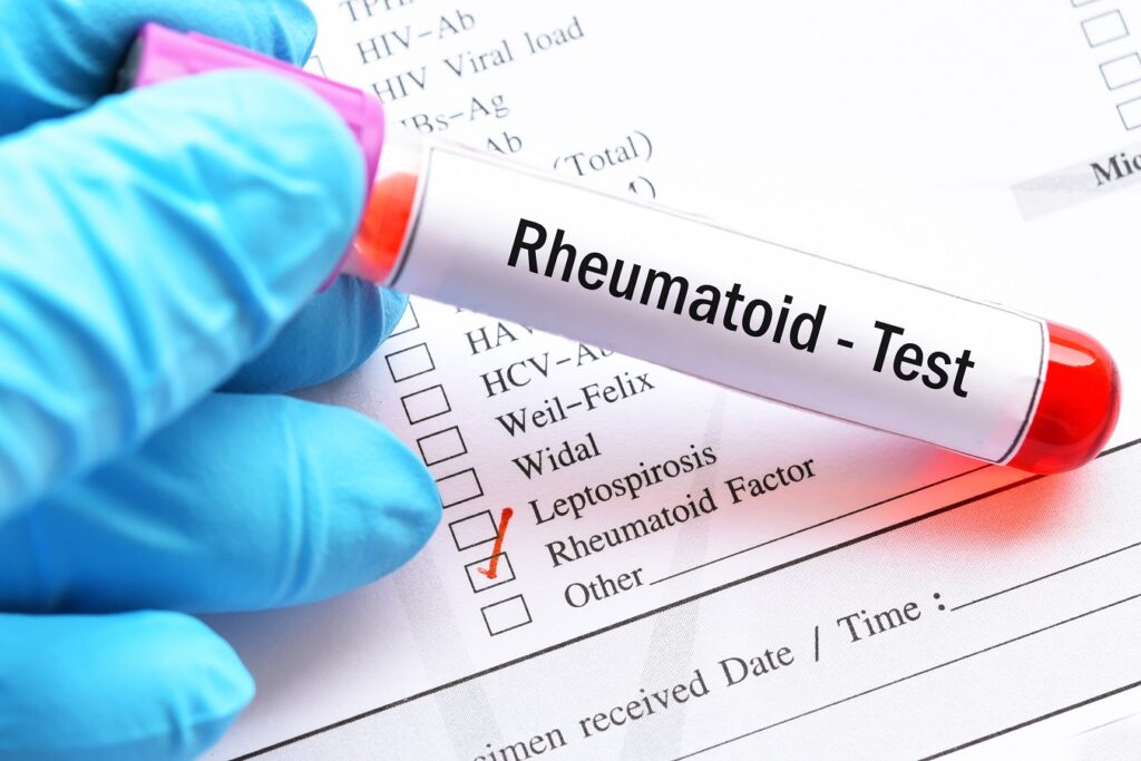 Factor reumatoid – informații valori normale, cauze valori crescute ...