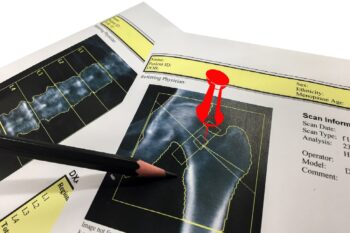 Osteopenie – manifestări clinice, cauze și management